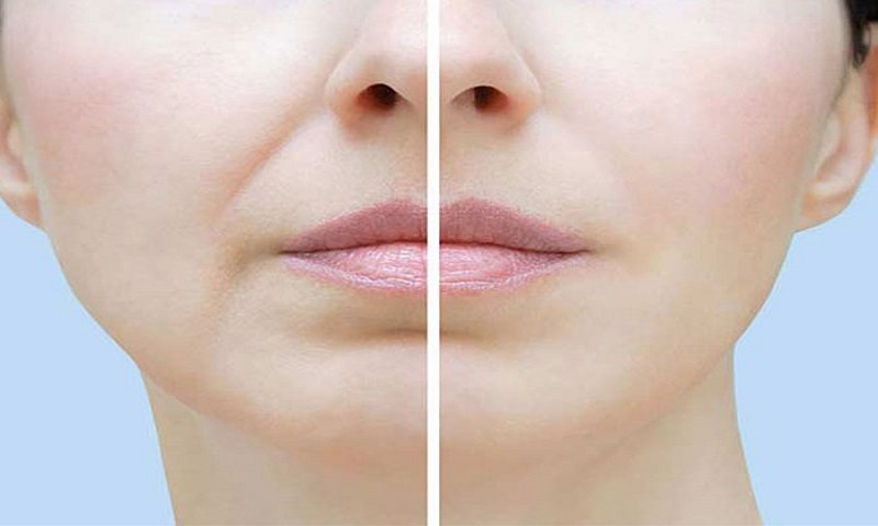 برای خط خنده بوتاکس بهتره یا ژل